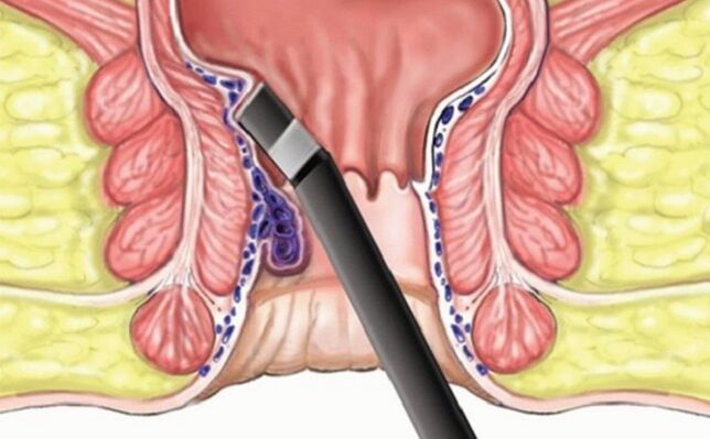 hemoroidlerde hemoroidlerin pıhtılaşması